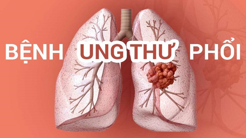 Ung thư phổi là một loại bệnh lý ác tính gây ho ra máu